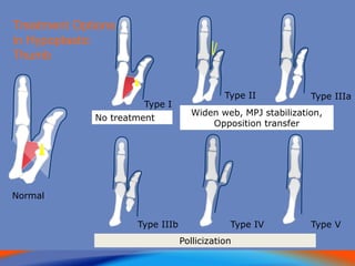Normal
No treatment
Widen web, MPJ stabilization,
Opposition transfer
Pollicization
Treatment Options
in Hypoplastic
Thumb
Type I
Type II Type IIIa
Type IIIb Type IV Type V
 