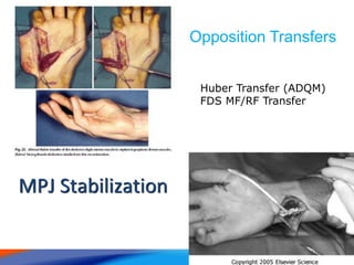 Opposition Transfers
• Huber Transfer
MPJ Stabilization
Huber Transfer (ADQM)
FDS MF/RF Transfer
 