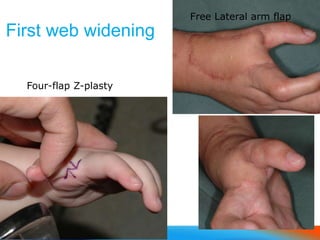 First web widening
Four-flap Z-plasty
Free Lateral arm flap
 