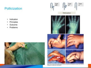 Pollicization
• Indication
• Principles
• Outcome
• Problems
Pollicization
Type
IIIb
Type
IV
Type
V
 
