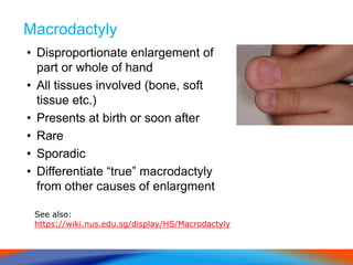 Macrodactyly
• Disproportionate enlargement of
part or whole of hand
• All tissues involved (bone, soft
tissue etc.)
• Presents at birth or soon after
• Rare
• Sporadic
• Differentiate “true” macrodactyly
from other causes of enlargment
See also:
https://wiki.nus.edu.sg/display/HS/Macrodactyly
 