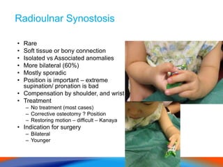 Radioulnar Synostosis
• Rare
• Soft tissue or bony connection
• Isolated vs Associated anomalies
• More bilateral (60%)
• Mostly sporadic
• Position is important – extreme
supination/ pronation is bad
• Compensation by shoulder, and wrist
• Treatment
– No treatment (most cases)
– Corrective osteotomy ? Position
– Restoring motion – difficult – Kanaya
• Indication for surgery
– Bilateral
– Younger
 