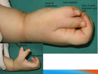 3/15/2008
Case 1
Level of
duplication Size of each
duplicate and
nail
Joint stability
Position of
thumb
Web space
 