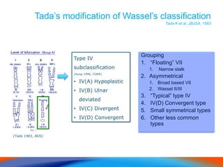 Tada’s modification of Wassel’s classification
Tada K et al, JBJSA, 1983
Grouping
1. “Floating” VII
1. Narrow stalk
2. Asymmetrical
1. Broad based VII
2. Wassel II/III
3. “Typical” type IV
4. IV(D) Convergent type
5. Small symmetrical types
6. Other less common
types
Type IV
subclassification
(Hung 1996, CORR)
• IV(A) Hypoplastic
• IV(B) Ulnar
deviated
• IV(C) Divergent
• IV(D) Convergent
(Tada 1983, JBJS)
 