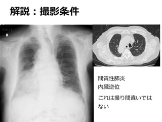 間質性肺炎
内臓逆位
これは撮り間違いでは
ない
解説：撮影条件
 