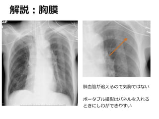 解説：胸膜
肺血管が追えるので気胸ではない
ポータブル撮影はパネルを入れる
ときにしわができやすい
 