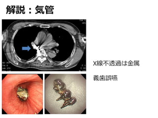 解説：気管
X線不透過は金属
義歯誤嚥
 