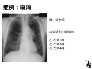 症例：縦隔
肺小細胞癌
縦隔陰影の異常は
① 右第1弓
② 左第2弓
③ 左第4弓
 
