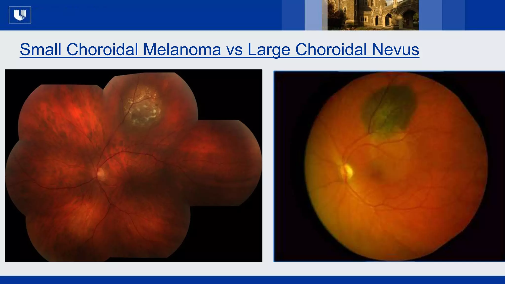 The Past, Present and Future of Uveal Melanoma - 2019 CURE OM Symposium ...