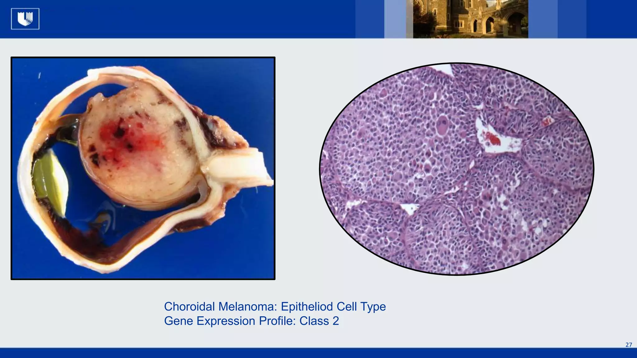 The Past, Present and Future of Uveal Melanoma - 2019 CURE OM Symposium ...