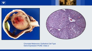 All Rights Reserved, Duke Medicine 2007
27
Choroidal Melanoma: Epitheliod Cell Type
Gene Expression Profile: Class 2
 