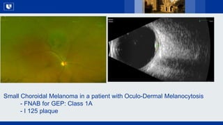 All Rights Reserved, Duke Medicine 2007
Small Choroidal Melanoma in a patient with Oculo-Dermal Melanocytosis
- FNAB for G...