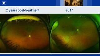 The Past, Present and Future of Uveal Melanoma - 2019 CURE OM Symposium