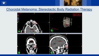 All Rights Reserved, Duke Medicine 2007
Choroidal Melanoma: Stereotactic Body Radiation Therapy
 