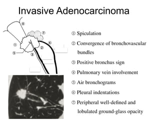 Spiculation Sign Comprehensive High-Resolution CT Imaging and Classification of Lung ...
