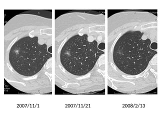 Comprehensive High-Resolution CT Imaging and Classification of Lung ...