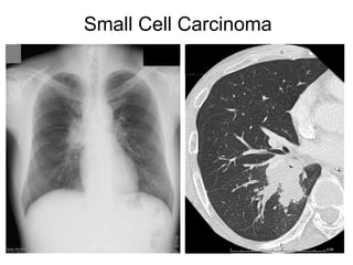 Comprehensive High-Resolution CT Imaging and Classification of Lung ...