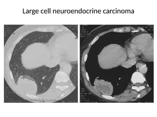 Comprehensive High-Resolution CT Imaging and Classification of Lung ...