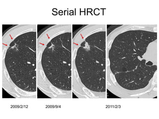 Comprehensive High-Resolution CT Imaging and Classification of Lung ...