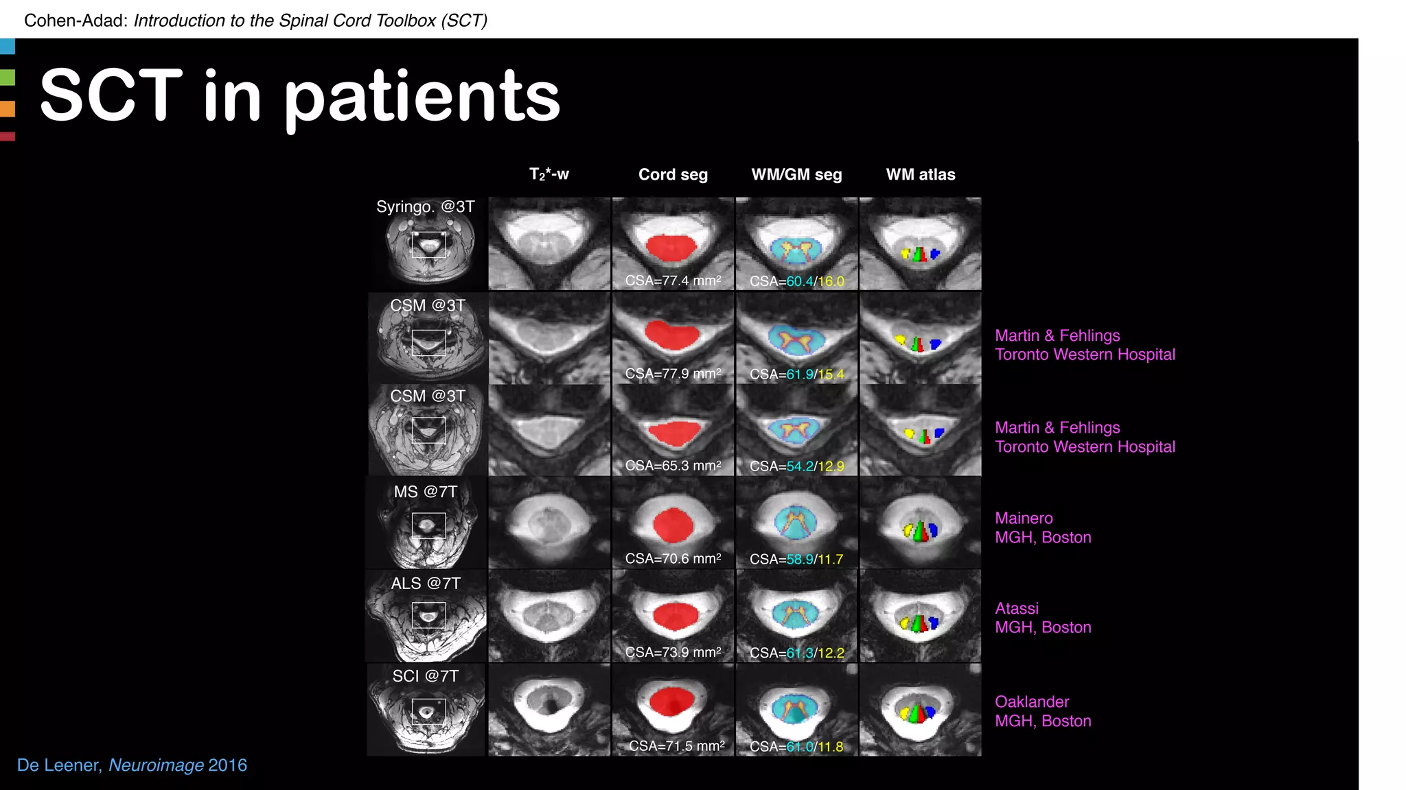 Cohen-Adad: Introduction to the Spinal Cord Toolbox (SCT)
SCT in patients
16
T2*-w WM atlas
Syringo. @3T
Cord seg
CSA=77.4 mm2
WM/GM seg
CSA=60.4/16.0
CSM @3T
CSA=77.9 mm2 CSA=61.9/15.4
Martin & Fehlings
Toronto Western Hospital
CSM @3T
CSA=65.3 mm2 CSA=54.2/12.9
Martin & Fehlings
Toronto Western Hospital
MS @7T
CSA=70.6 mm2 CSA=58.9/11.7
Mainero
MGH, Boston
ALS @7T
CSA=73.9 mm2 CSA=61.3/12.2
Atassi
MGH, Boston
SCI @7T
CSA=71.5 mm2 CSA=61.0/11.8
Oaklander
MGH, Boston
De Leener, Neuroimage 2016
 