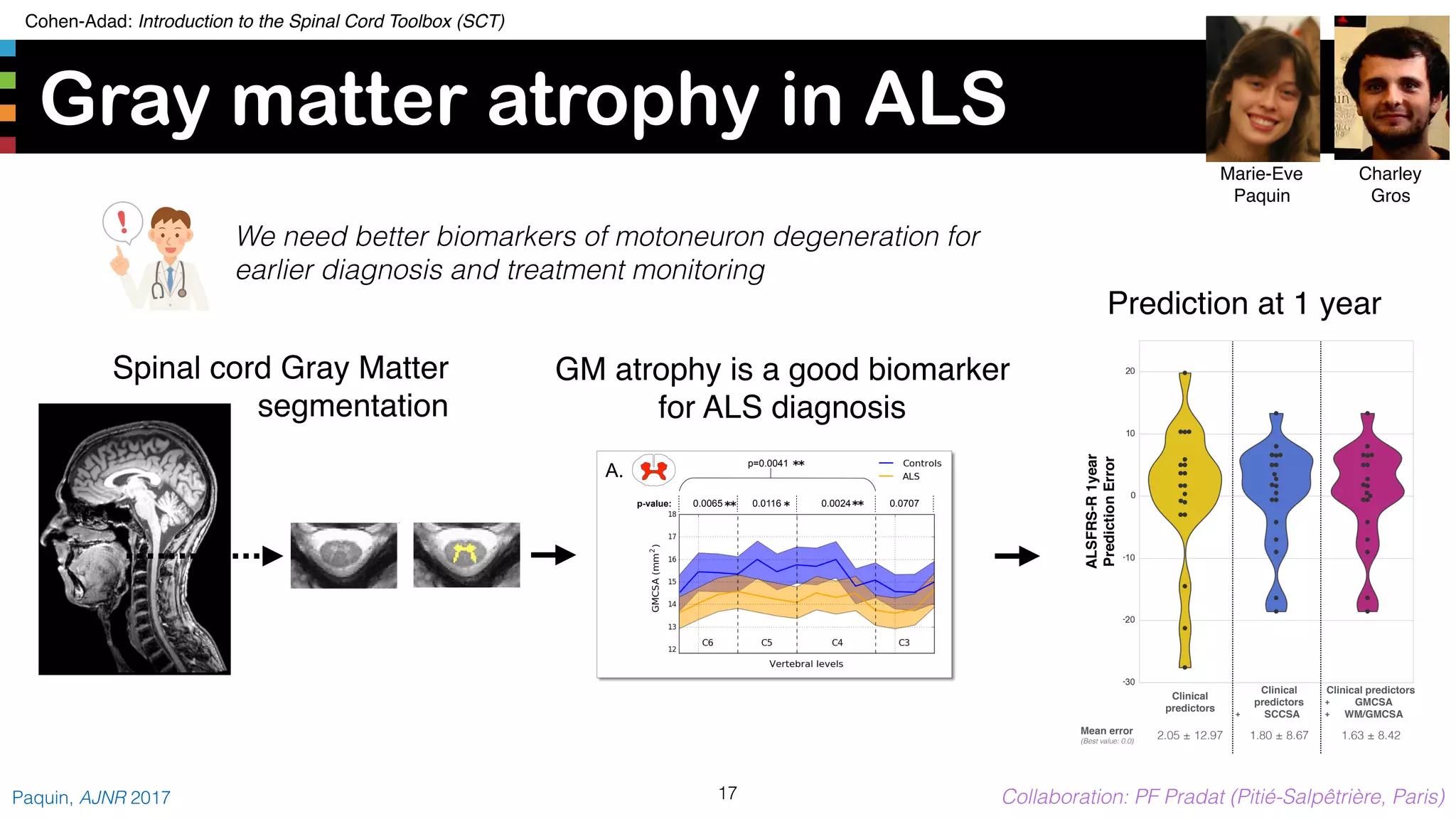 Cohen-Adad: Introduction to the Spinal Cord Toolbox (SCT)
Gray matter atrophy in ALS
17Paquin, AJNR 2017 Collaboration: PF Pradat (Pitié-Salpêtrière, Paris)
p-value:
p=0.0041
p-value:
p=0.0203
A.
B.
0.0065 0.0116 0.0024 0.0707
0.0045 0.0530 0.0337 0.0412
GM atrophy is a good biomarker
for ALS diagnosis
ALSFRS-R1year
PredictionError
Clinical
predictors
Clinical
predictors
+ SCCSA
Clinical predictors
+ GMCSA
+ WM/GMCSA
Mean error
(Best value: 0.0)
2.05 ± 12.97 1.80 ± 8.67 1.63 ± 8.42
Prediction at 1 year
Charley
Gros
Marie-Eve
Paquin
Spinal cord Gray Matter
segmentation
We need better biomarkers of motoneuron degeneration for
earlier diagnosis and treatment monitoring
 