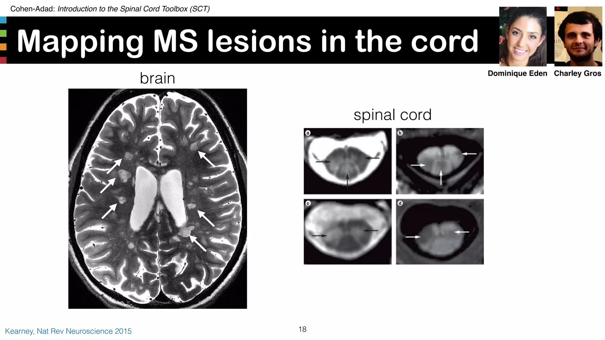 Cohen-Adad: Introduction to the Spinal Cord Toolbox (SCT)
Mapping MS lesions in the cord
18Kearney, Nat Rev Neuroscience 2015
Charley GrosDominique Eden
brain
spinal cord
 