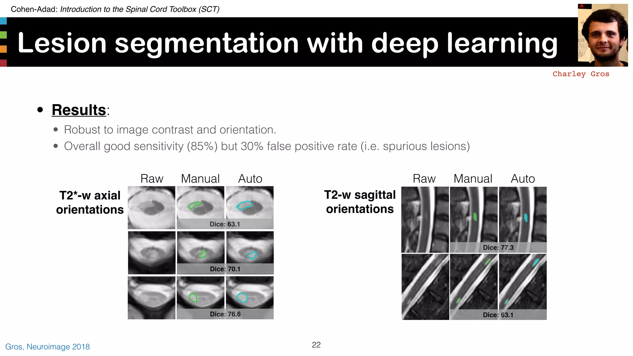 Cohen-Adad: Introduction to the Spinal Cord Toolbox (SCT)
Lesion segmentation with deep learning x
22Gros, Neuroimage 2018
Charley Gros
Dice: 63.1
Dice: 70.1
Dice: 76.6 Dice: 63.1
Dice: 77.3
T2*-w axial
orientations
T2-w sagittal
orientations
Raw Manual Auto Raw Manual Auto
• Results:
• Robust to image contrast and orientation.
• Overall good sensitivity (85%) but 30% false positive rate (i.e. spurious lesions)
 