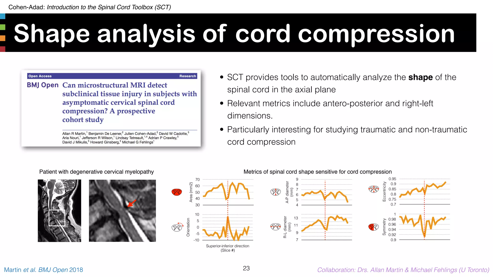 Cohen-Adad: Introduction to the Spinal Cord Toolbox (SCT)
Shape analysis of cord compression
23Martin et al. BMJ Open 2018 Collaboration: Drs. Allan Martin & Michael Fehlings (U Toronto)
• SCT provides tools to automatically analyze the shape of the
spinal cord in the axial plane
• Relevant metrics include antero-posterior and right-left
dimensions.
• Particularly interesting for studying traumatic and non-traumatic
cord compression
Patient with degenerative cervical myelopathy
A-Pdiameter
(mm)
4
5
6
7
8
9
Area(mm2)
30
40
50
60
70
Eccentricity
0.7
0.75
0.8
0.85
0.9
0.95
Symmetry
0.9
0.92
0.94
0.96
0.98
1
Orientation
-10
-5
0
5
10
Superior-inferior direction
(Slice #)
R-Ldiameter
(mm)
7
9
11
13
Metrics of spinal cord shape sensitive for cord compression
 