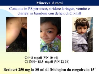 Minerva, 8 mesi
C4= 8 mg/dl (VN 10-40)
C1INH= 18.3 mg/dl (VN 22-34)
Berinert 250 mg in 80 ml di fisiologica da eseguire in 15’
Condotta in PS per tosse, stridore laringeo, vomito e
diarrea in bambina con deficit di C1-InH
 