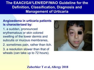 Angioedema in urticaria patients
is characterized by:
1. a sudden, pronounced
erythematous or skin colored
swelling of the lower dermis and
subcutis or mucous membranes,
2. sometimes pain, rather than itch.
3. a resolution slower than that of
wheals (can take up to 72 hours).
Position paper
EAACI/GA2LEN/EDF/WAO guideline: definition,
classification and diagnosis of urticaria
Position paper
EAACI/GA2LEN/EDF/WAO guideline: definition,
classification and diagnosis of urticaria
WAO Position Paper
Diagnosis and Treatment of Urticaria and Angioedema:
A Worldwide Perspective
The EAACI/GA²LEN/EDF/WAO Guideline for the
Definition, Classification, Diagnosis and
Management of Urticaria
Zuberbier T et al, Allergy 2018
 