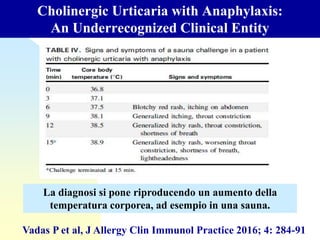 Cholinergic Urticaria with Anaphylaxis:
An Underrecognized Clinical Entity
Vadas P et al, J Allergy Clin Immunol Practice 2016; 4: 284-91
La diagnosi si pone riproducendo un aumento della
temperatura corporea, ad esempio in una sauna.
 