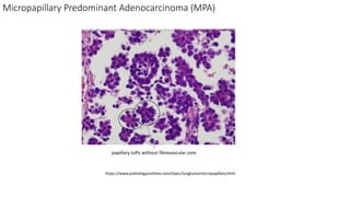 https://www.pathologyoutlines.com/topic/lungtumormicropapillary.html
papillary tufts without fibrovascular core
Micropapillary Predominant Adenocarcinoma (MPA)
 