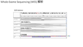 Whole-Exome Sequencing (WES) 
ATGC
EGFR deletion
M
΢С^
΢С^
 