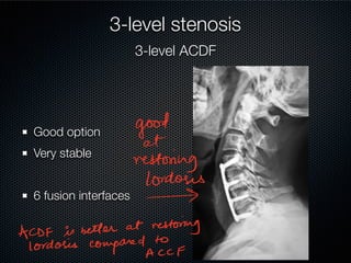 Cervical spondylotic myelopathy | PDF