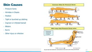 NAME OR LOGO
Skin Causes
○ Pressure Sores
○ Wrinkles in Sheets
○ Position
○ Tight or bunched up clothing
○ Ingrown or infected toenail
○ Blisters
○ Burns
○ Other injury or infection
 