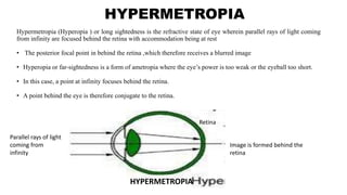 HYPERMETROPIA
Hypermetropia (Hyperopia ) or long sightedness is the refractive state of eye wherein parallel rays of light coming
from infinity are focused behind the retina with accommodation being at rest
• The posterior focal point in behind the retina ,which therefore receives a blurred image
• Hyperopia or far-sightedness is a form of ametropia where the eye’s power is too weak or the eyeball too short.
• In this case, a point at infinity focuses behind the retina.
• A point behind the eye is therefore conjugate to the retina.
Parallel rays of light
coming from
infinity
HYPERMETROPIA
Image is formed behind the
retina
Retina
 
