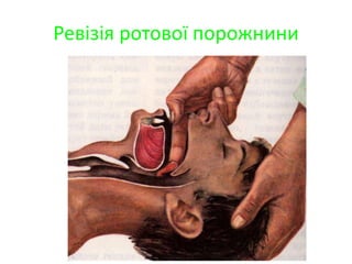 Ревізія ротової порожнини
 