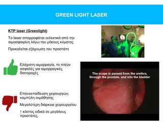 GREEN LIGHT LASER
KTP laser (Greenlight)
To laser απορροφάται εκλεκτικά από την
αιμοσφαιρίνη λόγω του μήκους κύματος
Προκαλείται εξάχνωση του προστάτη
Ελάχιστη αιμορραγία, το πλέον
ασφαλές για αιμορραγικές
διαταραχές
Επανεκπαίδευση χειρουργών,
καμπύλη εκμάθησης
Μεγαλύτερη διάρκεια χειρουργείου
↑ κόστος ειδικά σε μεγάλους
προστάτες,
 