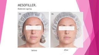 D0 D6
MESOFILLER.
Moderate ageing
Before After
 