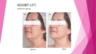 D0 D6
MESOBT-LIFT.
Moderate ageing
Before After
 