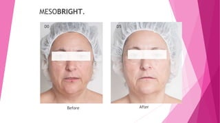 D0 D5
MESOBRIGHT.
Before After
 
