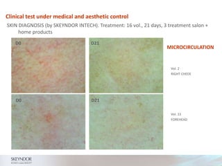 Clinical test under medical and aesthetic control
SKIN DIAGNOSIS (by SKEYNDOR INTECH). Treatment: 16 vol., 21 days, 3 treatment salon +
home products
MICROCIRCULATION
D0 D21
D0 D21
Vol. 2
RIGHT CHEEK
Vol. 11
FOREHEAD
 