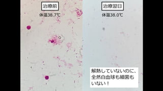 治療翌⽇
体温38.0℃
治療前
解熱していないのに、
全然⽩⾎球も細菌も
いない︕
体温38.7℃
 