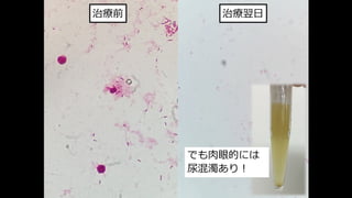 治療前
でも⾁眼的には
尿混濁あり︕
治療翌⽇
 