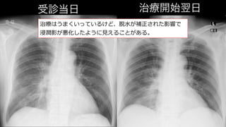 治療開始翌日
受診当日
治療はうまくいっているけど、脱⽔が補正された影響で
浸潤影が悪化したように⾒えることがある。
 