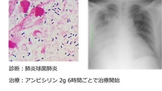診断︓肺炎球菌肺炎
治療︓アンピシリン 2g 6時間ごとで治療開始
 