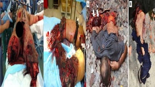 2021-Explosion Injuries-RP.pptx