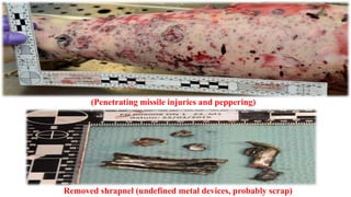 Schrapnel Injuries 2021-Explosion Injuries-RP.pptx