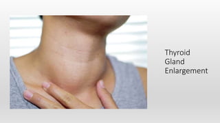 Thyroid
Gland
Enlargement
 