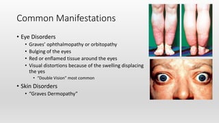 Common Manifestations
• Eye Disorders
• Graves’ ophthalmopathy or orbitopathy
• Bulging of the eyes
• Red or enflamed tissue around the eyes
• Visual distortions because of the swelling displacing
the yes
• “Double Vision” most common
• Skin Disorders
• “Graves Dermopathy”
 